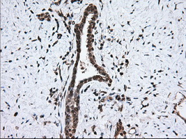 HMRF1L / MTRF1L Antibody - Immunohistochemical staining of paraffin-embedded Carcinoma of Human prostate tissue using anti-MTRF1L mouse monoclonal antibody. (Dilution 1:50).