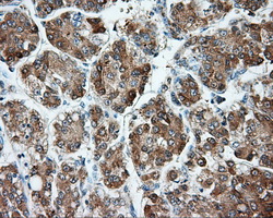 HMRF1L / MTRF1L Antibody - IHC of paraffin-embedded Carcinoma of liver tissue using anti-MTRF1L mouse monoclonal antibody. (Dilution 1:50).