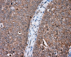 HMRF1L / MTRF1L Antibody - IHC of paraffin-embedded Adenocarcinoma of ovary tissue using anti-MTRF1L mouse monoclonal antibody. (Dilution 1:50).