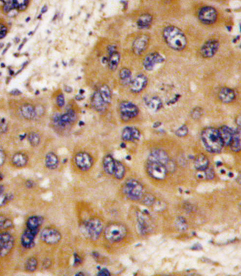 HMT / HNMT Antibody - Formalin-fixed and paraffin-embedded human hepatocarcinoma tissue reacted with HNMT antibody , which was peroxidase-conjugated to the secondary antibody, followed by DAB staining. This data demonstrates the use of this antibody for immunohistochemistry; clinical relevance has not been evaluated.