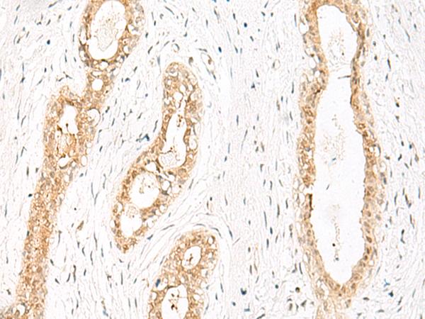 HN1 / ARM2 Antibody - Immunohistochemistry of paraffin-embedded Human breast cancer tissue  using JPT1 Polyclonal Antibody at dilution of 1:35(×200)