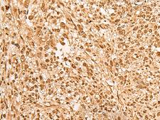 HN1L Antibody - Immunohistochemistry of paraffin-embedded Human liver cancer tissue  using JPT2 Polyclonal Antibody at dilution of 1:65(×200)