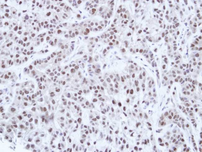 HNF1A / HNF1 Antibody - IHC of paraffin-embedded A549 Xenograft using HNF-1 alpha antibody at 1:100 dilution.