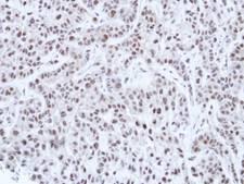 HNF1A / HNF1 Antibody - IHC of paraffin-embedded A549 Xenograft using HNF-1 alpha antibody at 1:100 dilution.