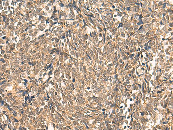 HNF1A / HNF1 Antibody - Immunohistochemistry of paraffin-embedded Human lung cancer tissue  using HNF1A Polyclonal Antibody at dilution of 1:50(×200)