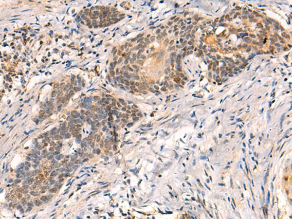 HNF1A / HNF1 Antibody - Immunohistochemistry of paraffin-embedded Human esophagus cancer tissue  using HNF1A Polyclonal Antibody at dilution of 1:50(×200)
