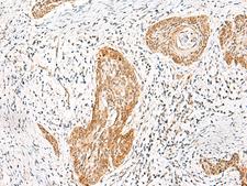 HNF1A / HNF1 Antibody - Immunohistochemistry of paraffin-embedded Human esophagus cancer tissue  using HNF1A Polyclonal Antibody at dilution of 1:25(×200)
