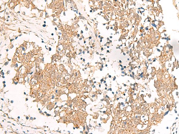 HNF1A / HNF1 Antibody - Immunohistochemistry of paraffin-embedded Human lung cancer tissue  using HNF1A Polyclonal Antibody at dilution of 1:25(×200)