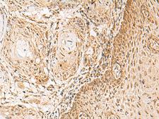 HNF1A / HNF1 Antibody - Immunohistochemistry of paraffin-embedded Human esophagus cancer tissue  using HNF1A Polyclonal Antibody at dilution of 1:30(×200)