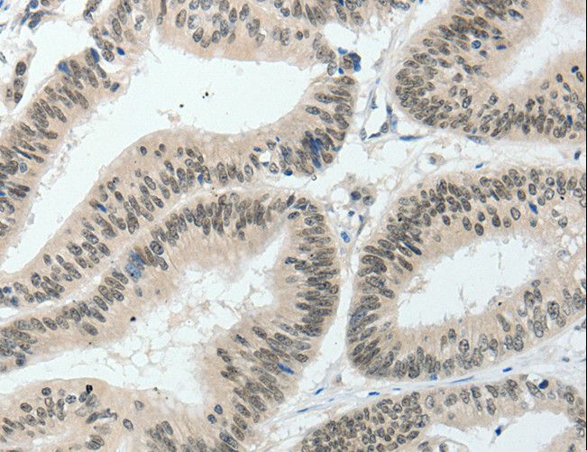 HNF1B / HNF1 Beta Antibody - Immunohistochemistry of paraffin-embedded Human lung cancer using HNF1B Polyclonal Antibody at dilution of 1:80.