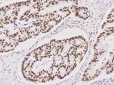 HNF1B / HNF1 Beta Antibody - Immunochemical staining of human HNF1B in human colon carcinoma with rabbit polyclonal antibody at 1:1000 dilution, formalin-fixed paraffin embedded sections.