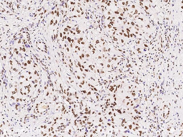 HNF1B / HNF1 Beta Antibody - Immunochemical staining of human HNF1B in human renal carcinoma with rabbit polyclonal antibody at 1:1000 dilution, formalin-fixed paraffin embedded sections.