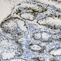 HNF4 Alpha+Gamma Antibody - Immunohistochemical analysis of HNF4 alpha/gamma staining in human colon cancer formalin fixed paraffin embedded tissue section. The section was pre-treated using heat mediated antigen retrieval with sodium citrate buffer (pH 6.0). The section was then incubated with the antibody at room temperature and detected using an HRP polymer system. DAB was used as the chromogen. The section was then counterstained with hematoxylin and mounted with DPX.