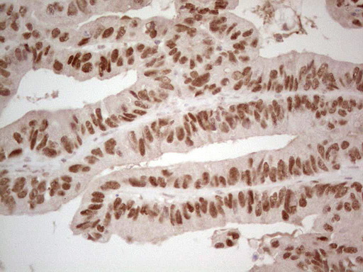 HNF4A / HNF4 Antibody - Immunohistochemical staining of paraffin-embedded Adenocarcinoma of Human colon tissue using anti-HNF4A mouse monoclonal antibody. (Heat-induced epitope retrieval by 1 mM EDTA in 10mM Tris, pH8.5, 120C for 3min,