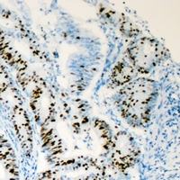 HNF4A / HNF4 Antibody - Immunohistochemical analysis of HNF4 alpha staining in human colon cancer formalin fixed paraffin embedded tissue section. The section was pre-treated using heat mediated antigen retrieval with sodium citrate buffer (pH 6.0). The section was then incubated with the antibody at room temperature and detected using an HRP polymer system. DAB was used as the chromogen. The section was then counterstained with hematoxylin and mounted with DPX.