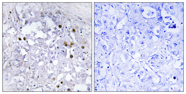HNF4A / HNF4 Antibody - Immunohistochemistry analysis of paraffin-embedded human liver carcinoma, using HNF4 alpha (Phospho-Ser313) Antibody. The picture on the right is blocked with the phospho peptide.