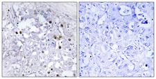 HNF4A / HNF4 Antibody - Immunohistochemistry analysis of paraffin-embedded human liver carcinoma, using HNF4 alpha (Phospho-Ser313) Antibody. The picture on the right is blocked with the phospho peptide.