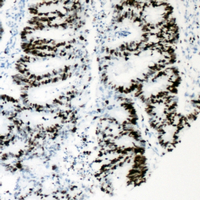 HNF4A / HNF4 Antibody - Immunohistochemical analysis of HNF4 alpha (pS313) staining in human colon cancer formalin fixed paraffin embedded tissue section. The section was pre-treated using heat mediated antigen retrieval with sodium citrate buffer (pH 6.0). The section was then incubated with the antibody at room temperature and detected using an HRP conjugated compact polymer system. DAB was used as the chromogen. The section was then counterstained with hematoxylin and mounted with DPX.