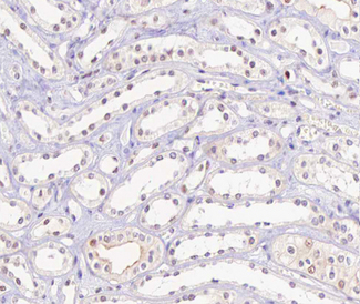 HNF4A / HNF4 Antibody - 1:100 staining human kidney carcinoma tissue by IHC-P. The tissue was formaldehyde fixed and a heat mediated antigen retrieval step in citrate buffer was performed. The tissue was then blocked and incubated with the antibody for 1.5 hours at 22°C. An HRP conjugated goat anti-rabbit antibody was used as the secondary.