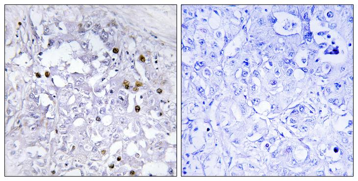 HNF4A / HNF4 Antibody - P-peptide - + Immunohistochemistry analysis of paraffin-embedded human liver carcinoma tissue using HNF4a (Phospho-Ser313) antibody.