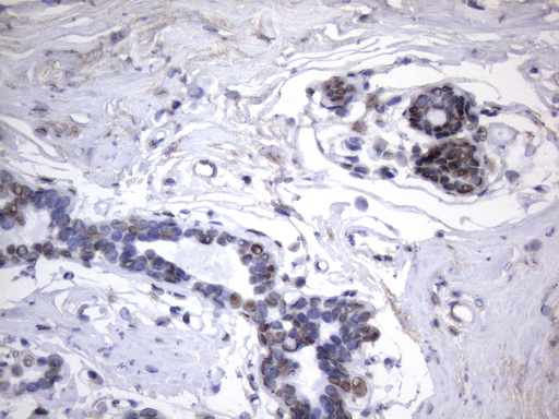 HnRNP A0 Antibody - Immunohistochemical staining of paraffin-embedded Human breast tissue within the normal limits using anti-HNRNPA0 mouse monoclonal antibody. (Heat-induced epitope retrieval by 1mM EDTA in 10mM Tris buffer. (pH8.5) at 120°C for 3 min. (1:150)