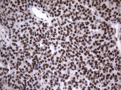 HnRNP A0 Antibody - Immunohistochemical staining of paraffin-embedded Carcinoma of Human thyroid tissue using anti-HNRNPA0 mouse monoclonal antibody. (Heat-induced epitope retrieval by 1mM EDTA in 10mM Tris buffer. (pH8.5) at 120°C for 3 min. (1:150)