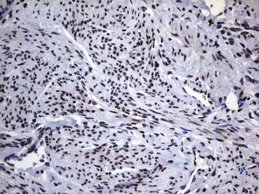 HnRNP A0 Antibody - Immunohistochemical staining of paraffin-embedded Human endometrium tissue within the normal limits using anti-HNRNPA0 mouse monoclonal antibody. (Heat-induced epitope retrieval by 1mM EDTA in 10mM Tris buffer. (pH8.5) at 120°C for 3 min. (1:150)