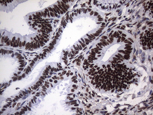 HnRNP A0 Antibody - Immunohistochemical staining of paraffin-embedded Adenocarcinoma of Human endometrium tissue using anti-HNRNPA0 mouse monoclonal antibody. (Heat-induced epitope retrieval by 1mM EDTA in 10mM Tris buffer. (pH8.5) at 120°C for 3 min. (1:150)