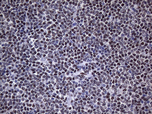 HnRNP A0 Antibody - Immunohistochemical staining of paraffin-embedded Human lymphoma tissue using anti-HNRNPA0 mouse monoclonal antibody. (Heat-induced epitope retrieval by 1mM EDTA in 10mM Tris buffer. (pH8.5) at 120°C for 3 min. (1:150)