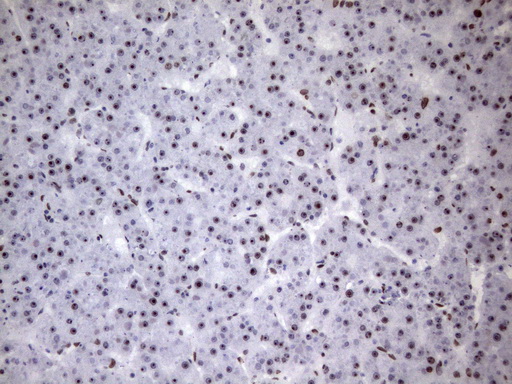HnRNP A0 Antibody - Immunohistochemical staining of paraffin-embedded Carcinoma of Human liver tissue using anti-HNRNPA0 mouse monoclonal antibody. (Heat-induced epitope retrieval by 1mM EDTA in 10mM Tris buffer. (pH8.5) at 120°C for 3 min. (1:150)