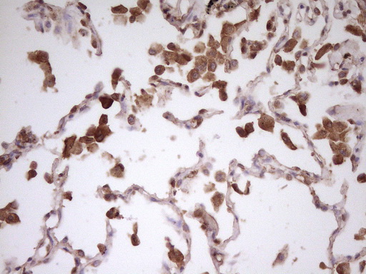 HnRNP-E1 / PCBP1 Antibody - Immunohistochemical staining of paraffin-embedded Carcinoma of Human lung tissue using anti-PCBP1 mouse monoclonal antibody. (Heat-induced epitope retrieval by 1 mM EDTA in 10mM Tris, pH8.5, 120C for 3min,
