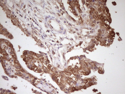 HnRNP-E1 / PCBP1 Antibody - Immunohistochemical staining of paraffin-embedded Adenocarcinoma of Human ovary tissue using anti-PCBP1 mouse monoclonal antibody. (Heat-induced epitope retrieval by 1 mM EDTA in 10mM Tris, pH8.5, 120C for 3min,