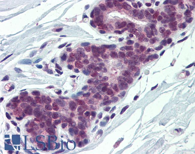 HnRNP-E1 / PCBP1 Antibody - Anti-PCBP1 antibody IHC of human breast. Immunohistochemistry of formalin-fixed, paraffin-embedded tissue after heat-induced antigen retrieval. Antibody concentration 5 ug/ml.  This image was taken for the unconjugated form of this product. Other forms have not been tested.