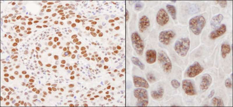HnRNP U Antibody - Detection of Human and Mouse hnRNP-U by Immunohistochemistry. Sample: FFPE section of human breast carcinoma (left) and mouse squamous cell carcinoma (right). Antibody: Affinity purified rabbit anti-hnRNP-U used at a dilution of 1:200 (1 Detection: DAB.
