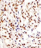 HNRNPA1L2 Antibody - Antibody staining HNRNPA1L2 in human breast carcinoma tissue sections by Immunohistochemistry (IHC-P - paraformaldehyde-fixed, paraffin-embedded sections). Tissue was fixed with formaldehyde and blocked with 3% BSA for 0. 5 hour at room temperature; antigen retrieval was by heat mediation with a citrate buffer (pH 6). Samples were incubated with primary antibody (1:25) for 1 hours at 37°C. A undiluted biotinylated goat polyvalent antibody was used as the secondary antibody.