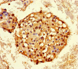 HNRNPA2B1 Antibody - Immunohistochemistry of paraffin-embedded human breast cancer using HNRNPA2B1 Antibody at dilution of 1:100