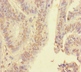 HNRNPA2B1 Antibody - Immunohistochemistry of paraffin-embedded human colon cancer using HNRNPA2B1 Antibody at dilution of 1:100