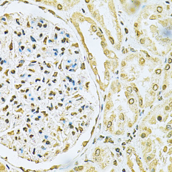HNRNPA2B1 Antibody - Immunohistochemistry of paraffin-embedded human kidney cancer using HNRNPA2B1 Antibodyat dilution of 1:200 (40x lens).