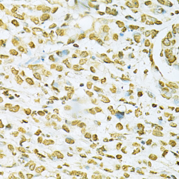 HNRNPA2B1 Antibody - Immunohistochemistry of paraffin-embedded human gastric cancer using HNRNPA2B1 Antibodyat dilution of 1:200 (40x lens).
