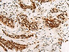 HNRNPA3 / HnRNP A3 Antibody - Immunohistochemistry of paraffin-embedded Human esophagus cancer tissue  using HNRNPA3 Polyclonal Antibody at dilution of 1:45(×200)