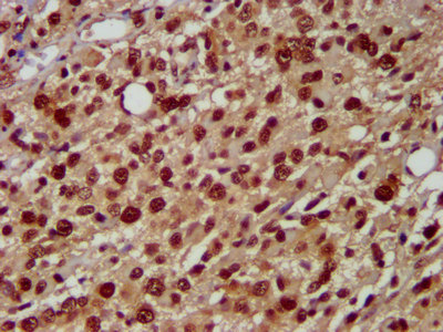 HNRNPAB Antibody - Immunohistochemistry image at a dilution of 1:500 and staining in paraffin-embedded human glioma cancer performed on a Leica BondTM system. After dewaxing and hydration, antigen retrieval was mediated by high pressure in a citrate buffer (pH 6.0) . Section was blocked with 10% normal goat serum 30min at RT. Then primary antibody (1% BSA) was incubated at 4 °C overnight. The primary is detected by a biotinylated secondary antibody and visualized using an HRP conjugated SP system.