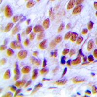 HNRNPC / HNRNP C Antibody - Immunohistochemical analysis of hNRNP C (pS260) staining in human breast cancer formalin fixed paraffin embedded tissue section. The section was pre-treated using heat mediated antigen retrieval with sodium citrate buffer (pH 6.0). The section was then incubated with the antibody at room temperature and detected using an HRP polymer system. DAB was used as the chromogen. The section was then counterstained with hematoxylin and mounted with DPX.