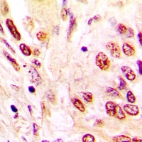 HNRNPC / HNRNP C Antibody - Immunohistochemical analysis of hNRNP C staining in human lung cancer formalin fixed paraffin embedded tissue section. The section was pre-treated using heat mediated antigen retrieval with sodium citrate buffer (pH 6.0). The section was then incubated with the antibody at room temperature and detected using an HRP polymer system. DAB was used as the chromogen. The section was then counterstained with hematoxylin and mounted with DPX.