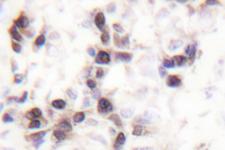 HNRNPC / HNRNP C Antibody - IHC of hnRNP C1/2 (G256)pAb in paraffin-embedded human breast carcinoma tissue.