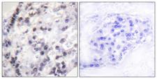 HNRNPC / HNRNP C Antibody - Peptide - + Immunohistochemistry analysis of paraffin-embedded human breast carcinoma tissue using hnRNP C1/2 (Ab-260) antibody.