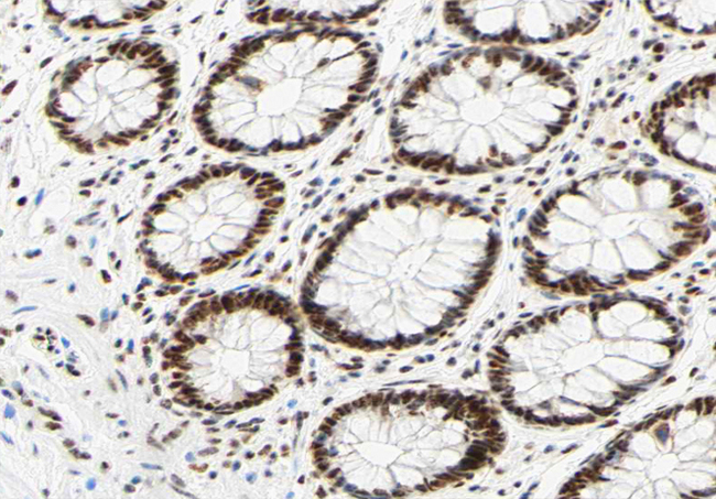 HNRNPC / HNRNP C Antibody - 1:200 staining human colon carcinoma tissue by IHC-P. The tissue was formaldehyde fixed and a heat mediated antigen retrieval step in citrate buffer was performed. The tissue was then blocked and incubated with the antibody for 1.5 hours at 22°C. An HRP conjugated goat anti-rabbit antibody was used as the secondary.
