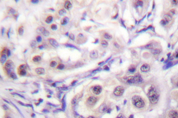 HNRNPD / AUF1 Antibody - IHC of hnRPD (H79) pAb in paraffin-embedded human lung carcinoma tissue.