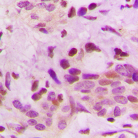 HNRNPD / AUF1 Antibody - Immunohistochemical analysis of hnRNP D0 staining in human breast cancer formalin fixed paraffin embedded tissue section. The section was pre-treated using heat mediated antigen retrieval with sodium citrate buffer (pH 6.0). The section was then incubated with the antibody at room temperature and detected using an HRP conjugated compact polymer system. DAB was used as the chromogen. The section was then counterstained with hematoxylin and mounted with DPX.