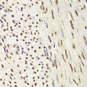 HNRNPD / AUF1 Antibody - Immunohistochemistry of paraffin-embedded Human adenoma of uterine muscle.