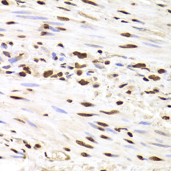HNRNPD / AUF1 Antibody - Immunohistochemistry of paraffin-embedded Human gastric cancer tissue.